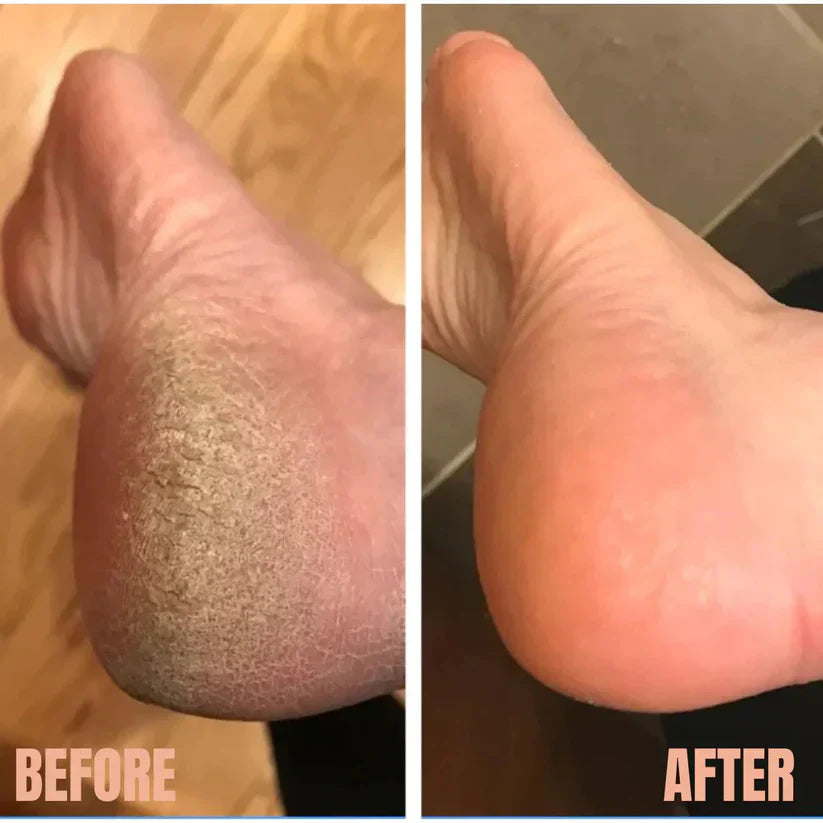 USB Foot Grinding Machine - Foot Care